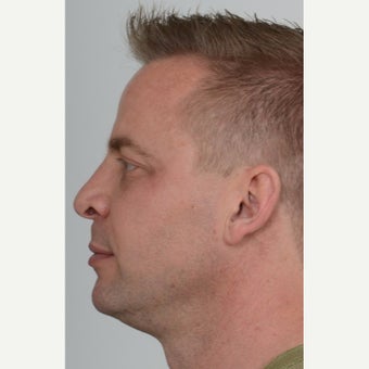 35-44 year old man treated with Teosyal Injectable filler after 2561037