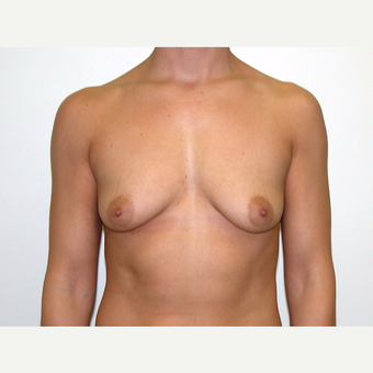 25-34 year old woman treated with Breast Augmentation before 3378482