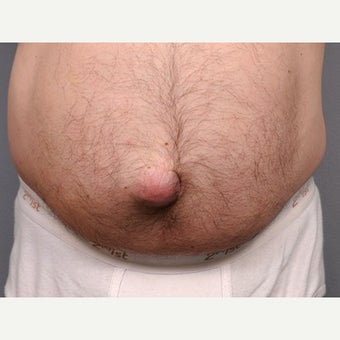 Belly Button Surgery with Umbilical Hernia before 1701777