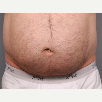 Belly Button Surgery with Umbilical Hernia after 1701777