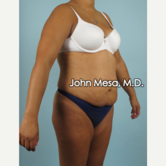 45-54 year old woman treated with Brazilian Butt Lift before 3777663