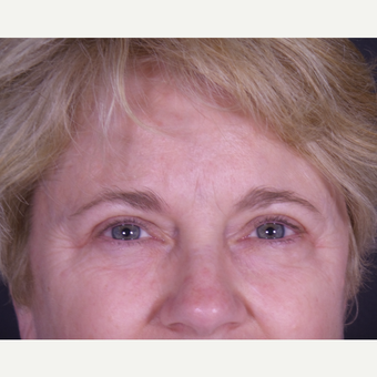 55-64 year old woman treated with Eyelid Surgery after 3059449