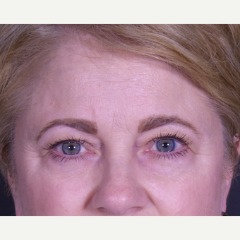 55-64 year old woman treated with Eyelid Surgery before 3059449