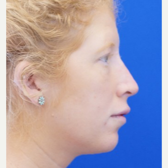 25-34 year old woman treated with Non Surgical Nose Job after 3711527