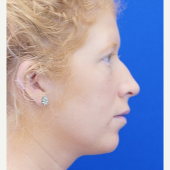25-34 year old woman treated with Non Surgical Nose Job before 3711527