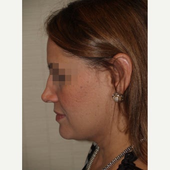 45-54 year old woman treated with Revision Rhinoplasty 1853488