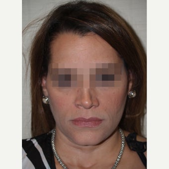 45-54 year old woman treated with Revision Rhinoplasty before 1853488