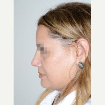 45-54 year old woman treated with Revision Rhinoplasty 1853488