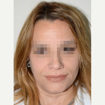 45-54 year old woman treated with Revision Rhinoplasty after 1853488
