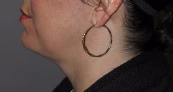 35-44 year old woman treated with Kybella after 3147392
