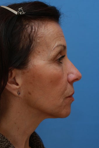 58 Year Old Lady After Revision Facelift 626857