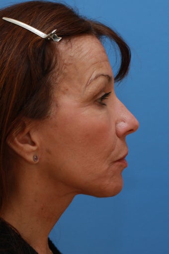 58 Year Old Lady After Revision Facelift 626857