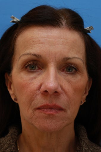 58 Year Old Lady After Revision Facelift before 626857