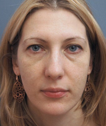 Cosmetic Injectables: Botox & Restylane L ~ 1CC Lower Eyelids before 1100408