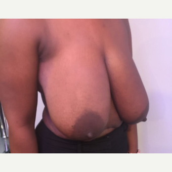25-34 year old woman treated with Breast Reduction before 3749882
