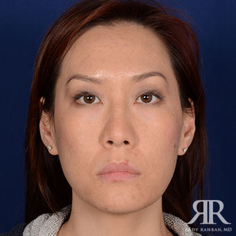 Rhinoplasty before 1357429