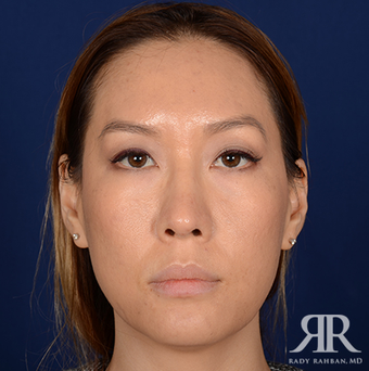 Rhinoplasty after 1357429