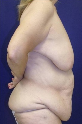 Body Lift before 1570759