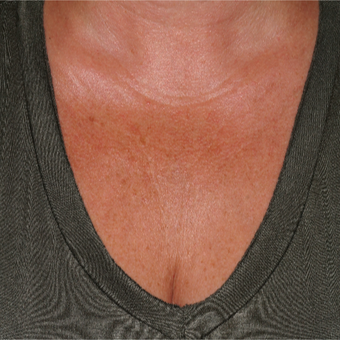 35-44 year old woman treated with Sculptra to help with the fine lines of the chest before 3172896