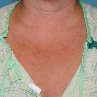 35-44 year old woman treated with Sculptra to help with the fine lines of the chest after 3172896