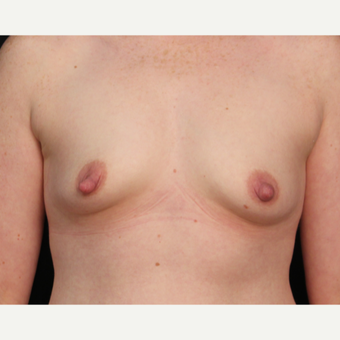 25-34 year old woman who underwent bilateral nipple reduction / shortening before 3488410