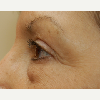 65-74 year old woman treated with Eye Bags Treatment before 3036576