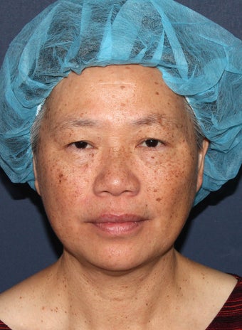 57 year old Asian female with age spots and brown spots before 1058216