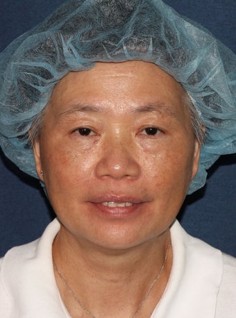 57 year old Asian female with age spots and brown spots after 1058216