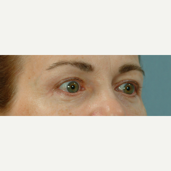 Eyelid Surgery after 3123636
