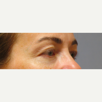 Eyelid Surgery before 3123636