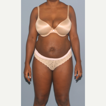 25-34 year old woman treated with Tummy Tuck before 3512755