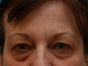 Woman interested in improvement of her tired appearance. (Eyelid Lift) before 1558255