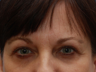 Woman interested in improvement of her tired appearance. (Eyelid Lift) after 1558255