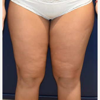 25-34 year old woman treated with Liposuction before 3420218