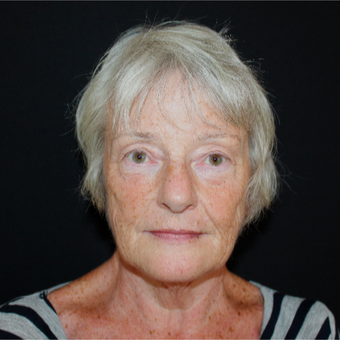65-74 year old woman treated with Lower Face Lift before 3602878