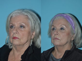 Lift provided to mid-face with Voluma before 1220998
