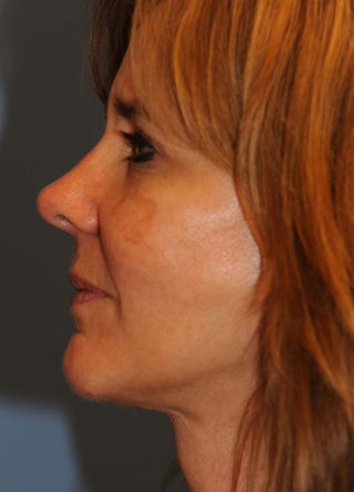 Facelift 1050966