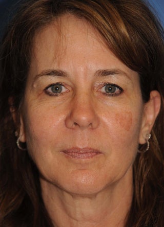 Facelift before 1050966