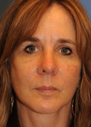 Facelift after 1050966