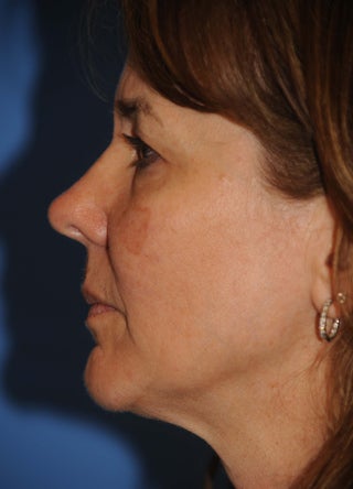 Facelift 1050966
