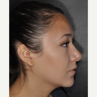 18-24 year old woman treated with Septoplasty 1 year post-op after 3708699
