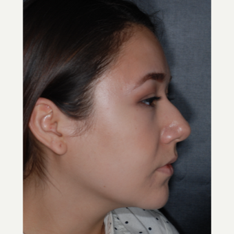 18-24 year old woman treated with Septoplasty 1 year post-op before 3708699