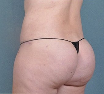 36 year old woman treated with Brazilian Butt Lift after 2630877