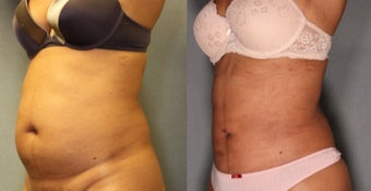 36 year old woman treated with Smart Lipo Laser Liposuction before 1811318