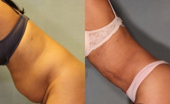 36 year old woman treated with Smart Lipo Laser Liposuction after 1811318