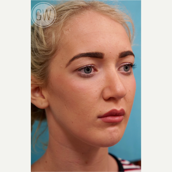18-24 year old woman treated with Nose Surgery after 3473427