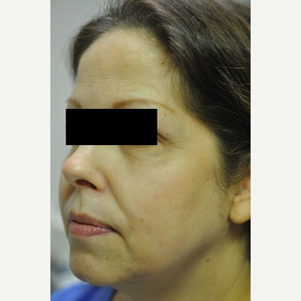 55-64 year old woman treated with TriPollar before 2699440