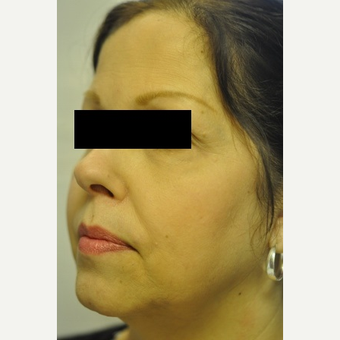 55-64 year old woman treated with TriPollar after 2699440
