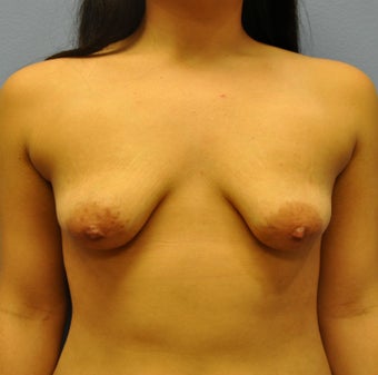 Breast Augmentation, Breast Implants, Mastopexy, Breast Lift before 1206851