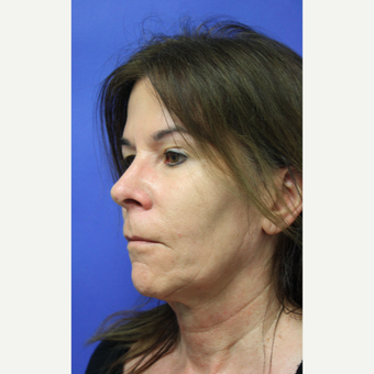 55-64 year old woman treated with Mini Lift before 3405888